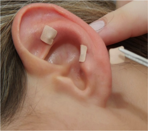 auriculterapia en bogota